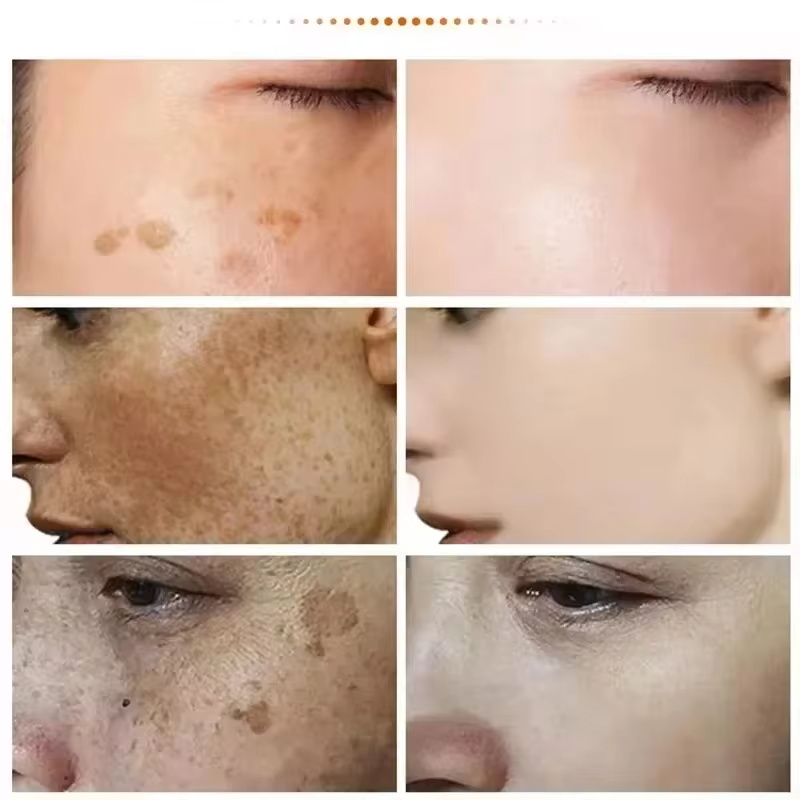 강력한 스팟 제거 화이트닝 크림 피부를 밝게 빠르게 멜 - Luxury Skincare Brands 리뷰 및 가격