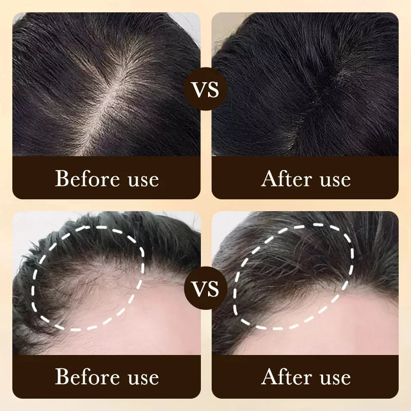 비오틴 빠른 모발 성장 오일 제품 케어 두피 마사지 트 - Epidermal Growth Factor 리뷰 및 가격