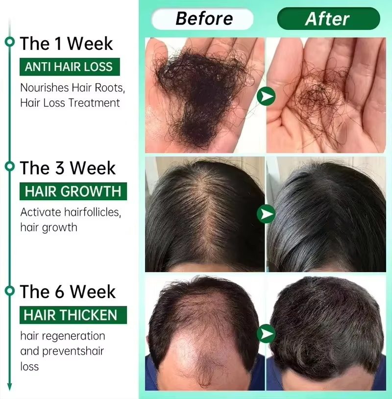 헤어 성장 세럼 7일 빠른 재성장 에센셜 캡슐 탈모 방 - Epidermal Growth Factor 리뷰 및 가격