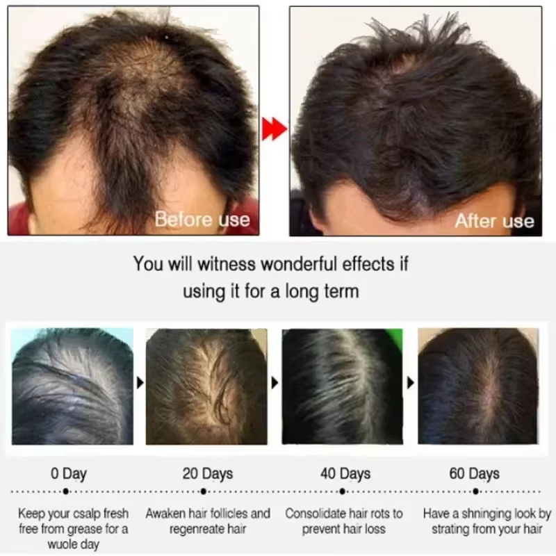 헤어 성장 세럼 7일 빠른 재성장 에센셜 캡슐 탈모 방 - Epidermal Growth Factor 리뷰 및 가격